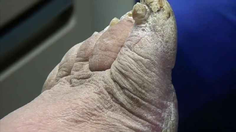 Are all thick toenails fungus
