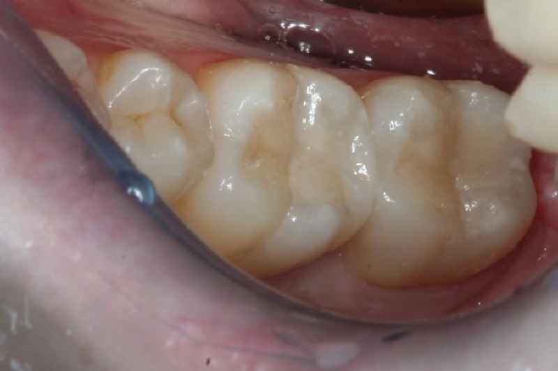 Are composite fillings considered cosmetic