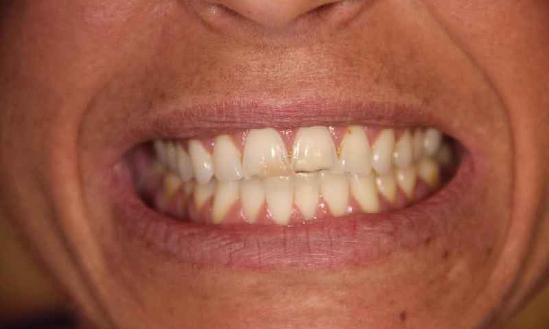Are crowns on front teeth considered cosmetic