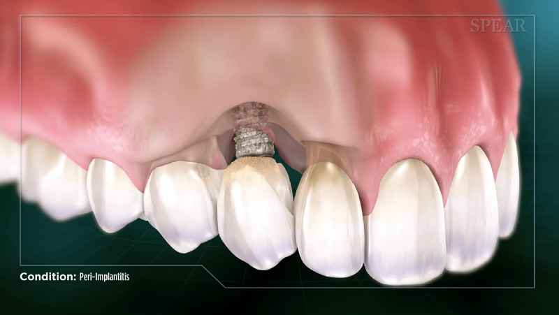 Are dental implants a cosmetic procedure
