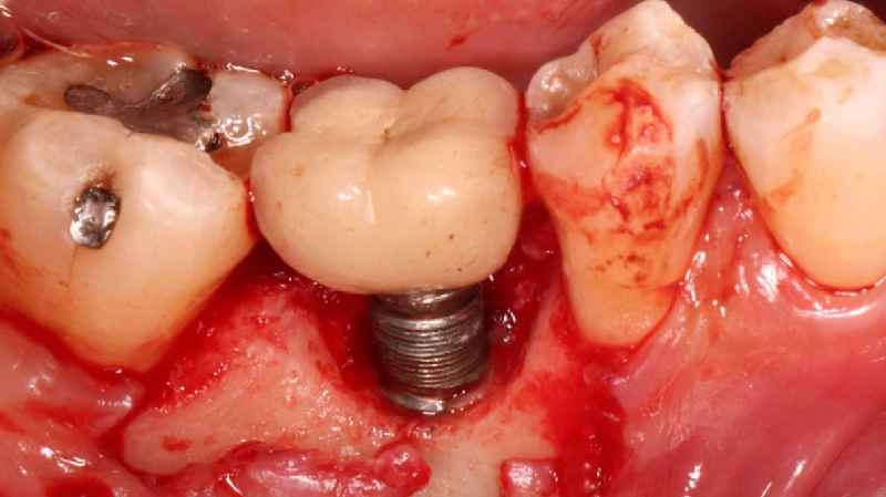 Are dental implants considered elective