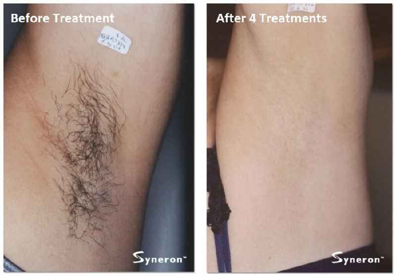 Are legs smooth after laser hair removal