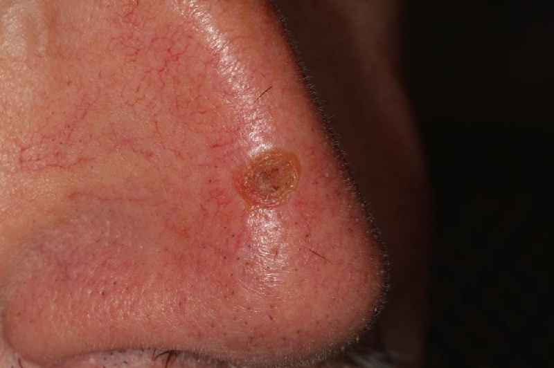 Are most skin cancers treatable