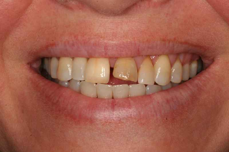 Are teeth implants cosmetic