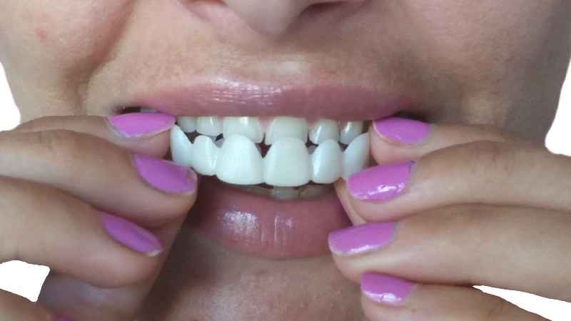 Are veneers considered orthodontia