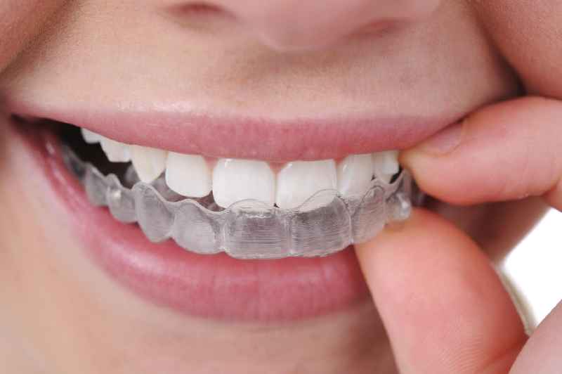Are veneers considered orthodontia
