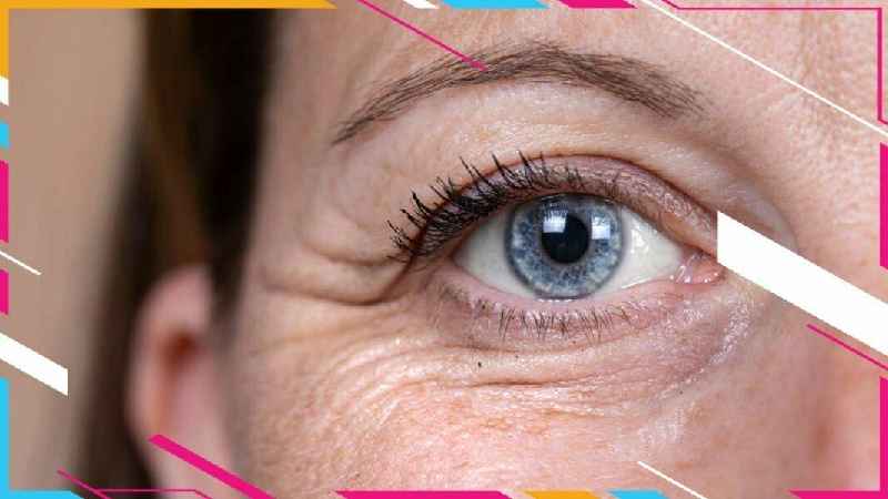 Are you put to sleep for eyelid surgery