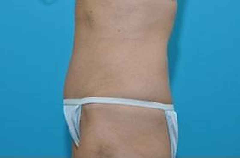 Can a 65 year old woman get a tummy tuck