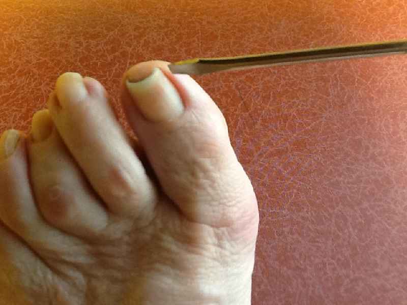 Can a black nail heal itself