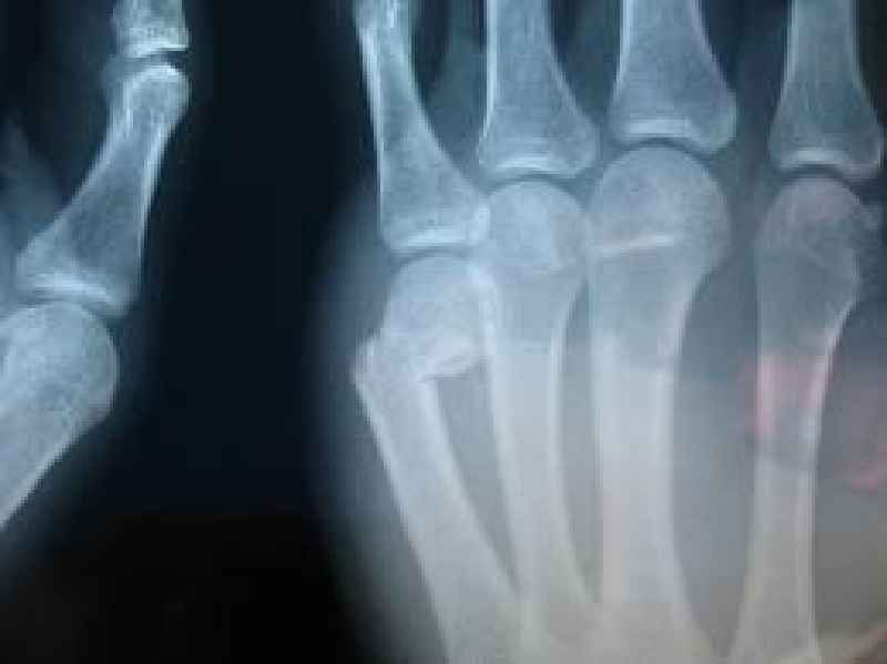 Can a broken finger heal itself