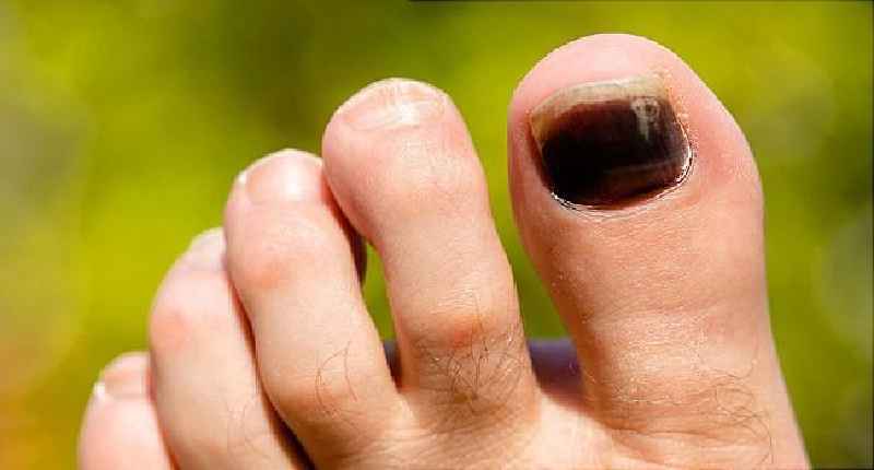 Can a damaged toenail bed be repaired