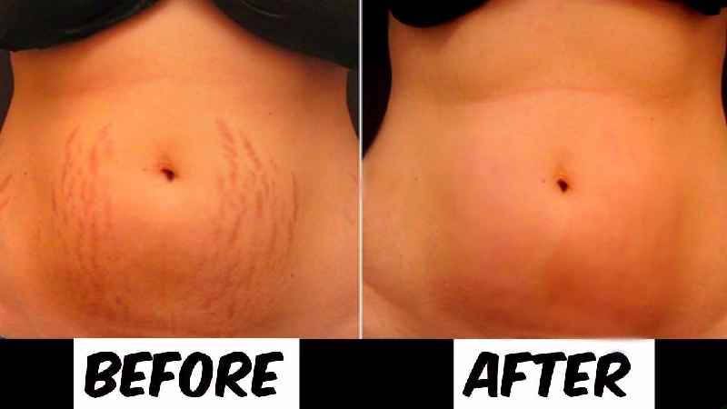 Can a dermatologist help with stretch marks
