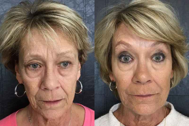 Can a facelift make you look 20 years younger