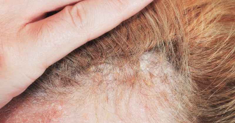 Can a gynecologist help with hair loss