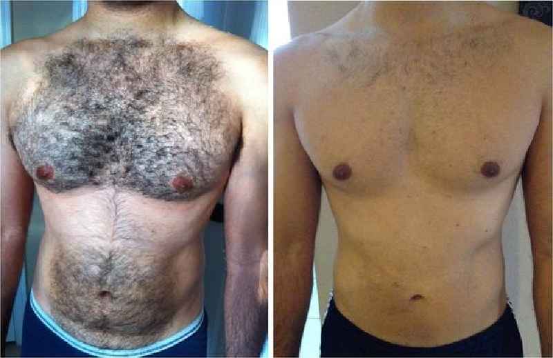 Can a man permanently remove facial hair