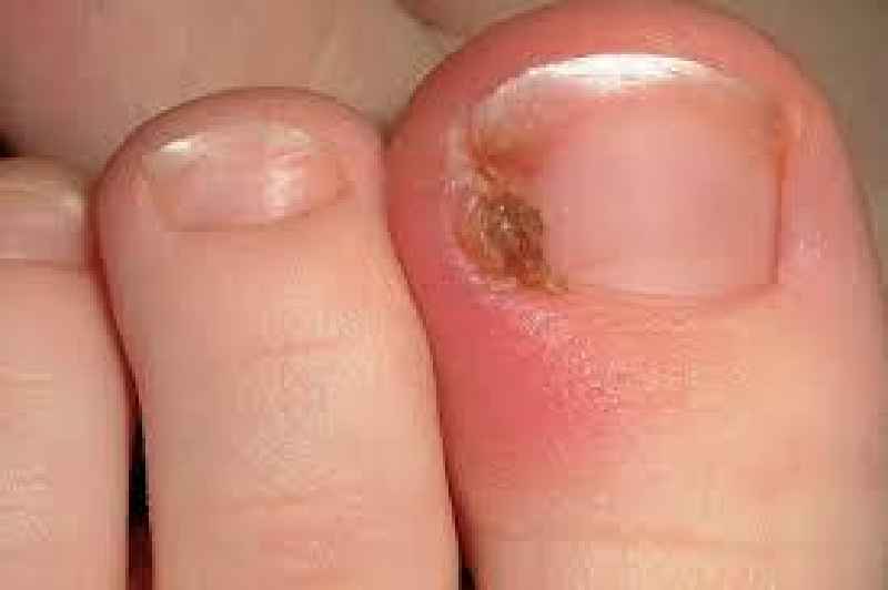 Can a nail salon fix ingrown toenail