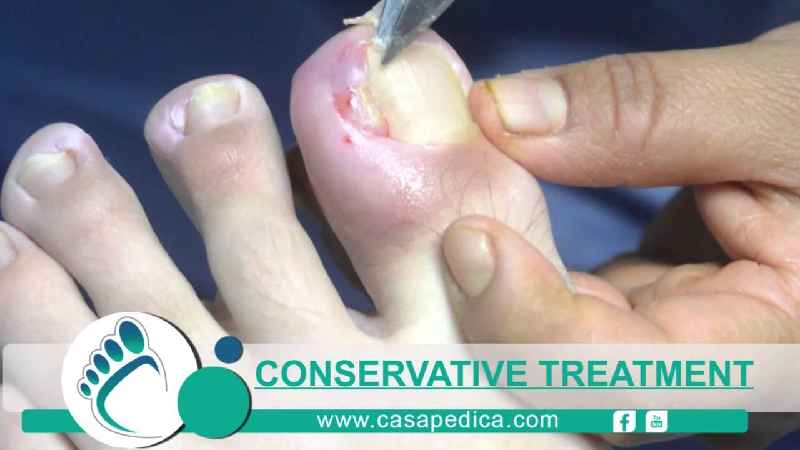 Can a pedicure fix an ingrown toenail