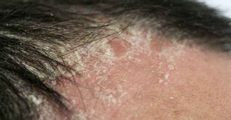 Can a virus cause hair loss