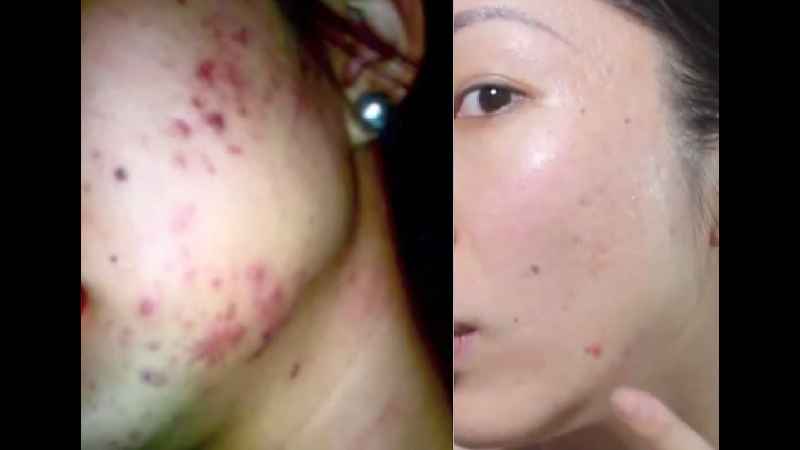 Can acne scars be removed