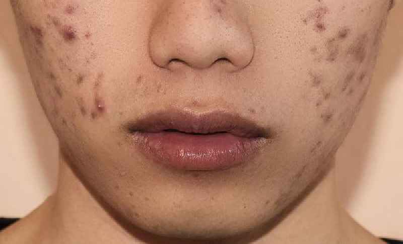 Can alcohol in skincare cause acne