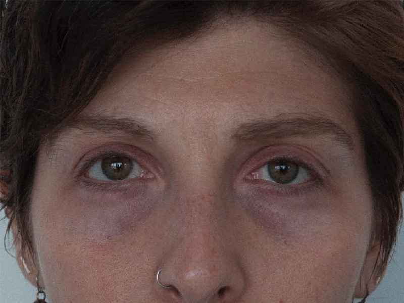 Can allergies give you a black eye