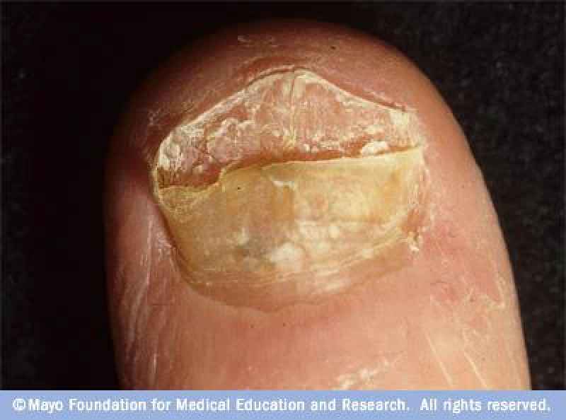 Can an infected finger cause sepsis
