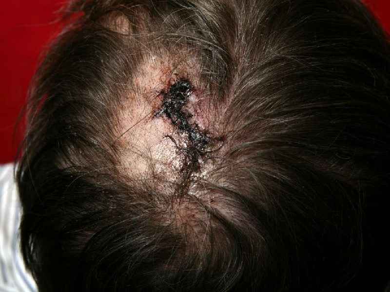 Can an infection cause hair loss