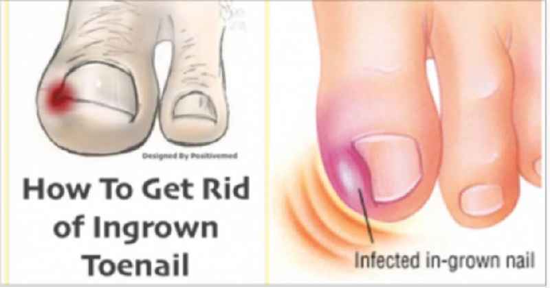 Can an ingrown toenail heal itself