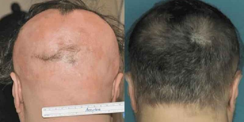 Can autoimmune hair loss be cured