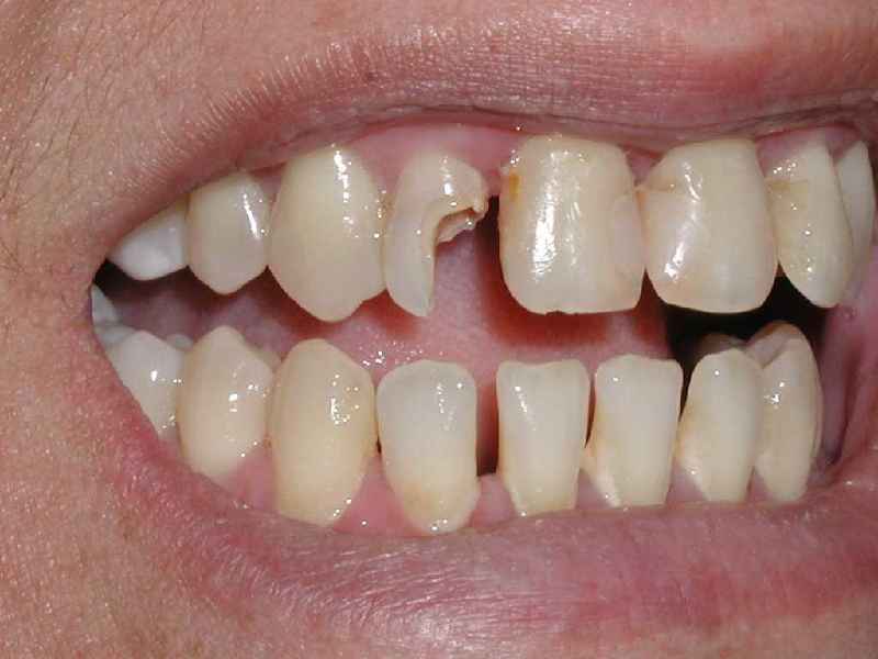 Can badly decayed teeth be saved