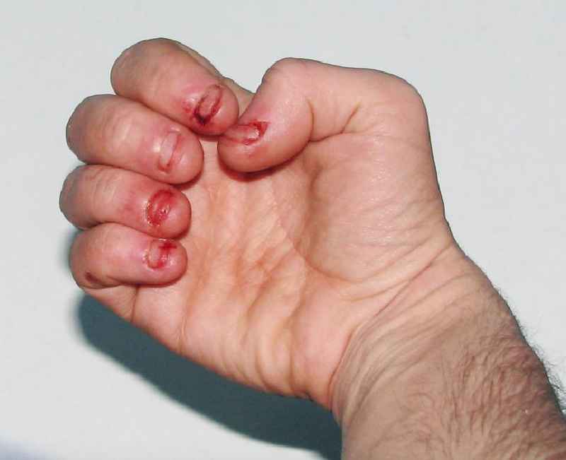 Can bitten nails grow back to normal