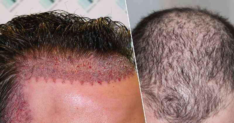 Can blood pressure meds cause hair loss