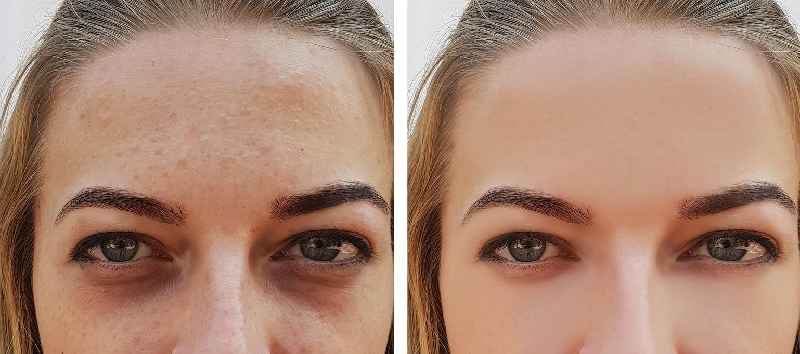 Can Botox fix bags under eyes