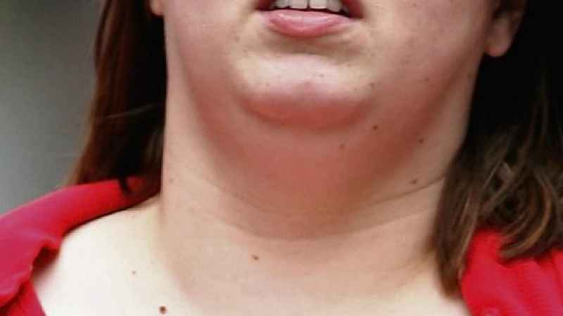 Can botox get rid of double chin