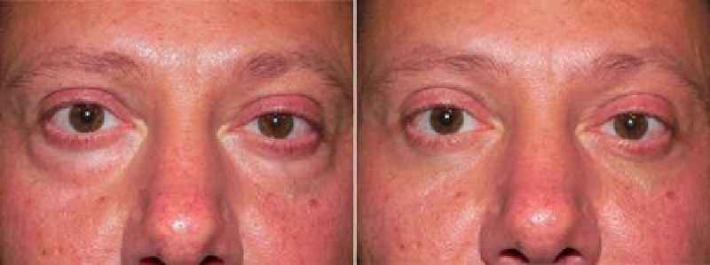 Can Botox help under eye bags