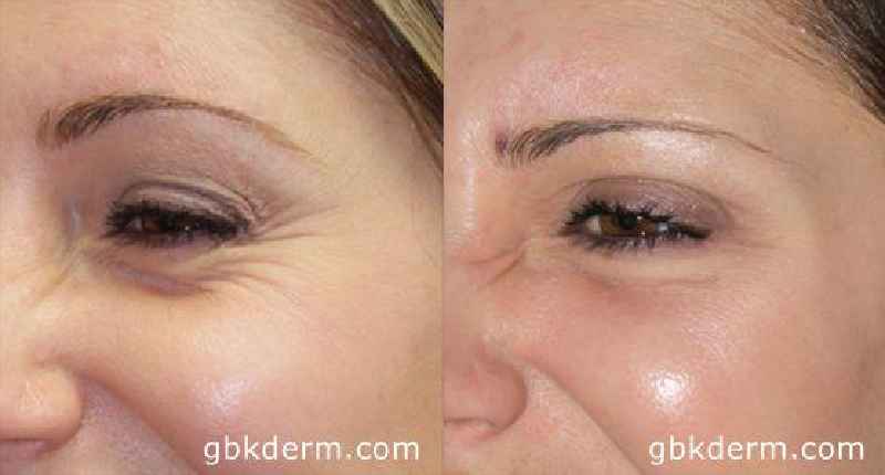 Can Botox help with crepey skin under eyes