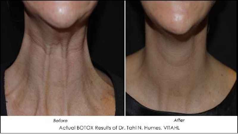 Can Botox lift sagging face