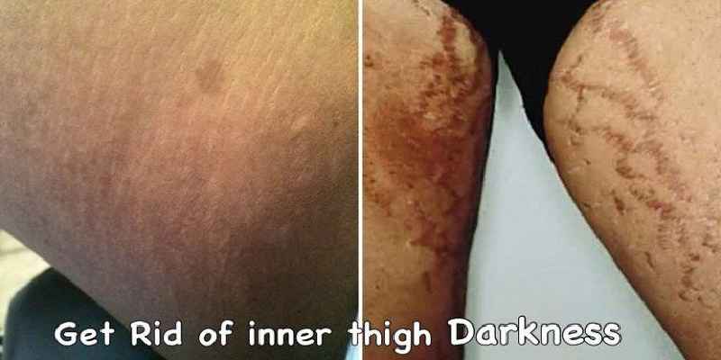 Can coconut oil darken the skin