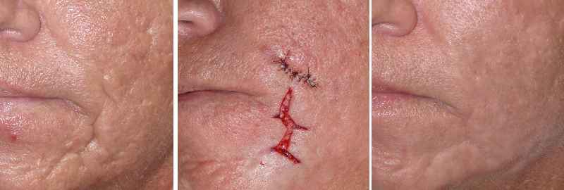 Can coconut remove acne scars