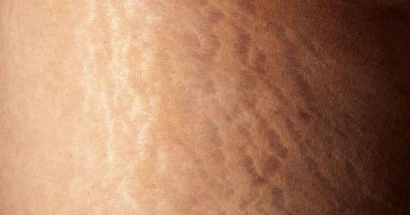 Can collagen reverse sagging skin