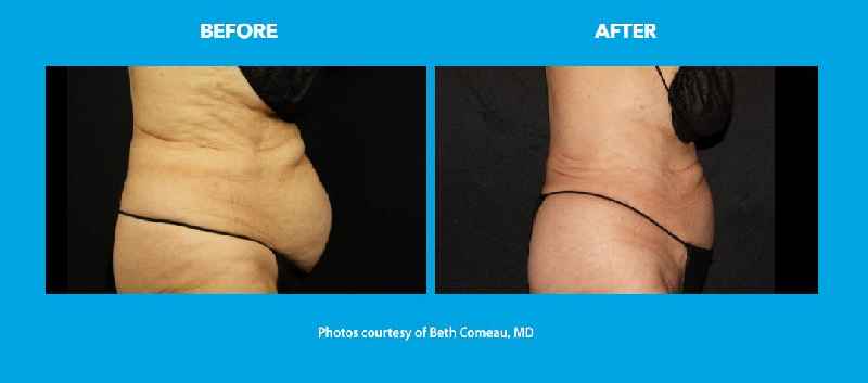 Can CoolSculpting get rid of menopause belly fat