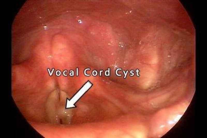 Can crying damage vocal cords