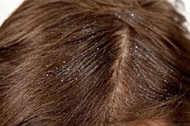 Can dandruff cause hair loss