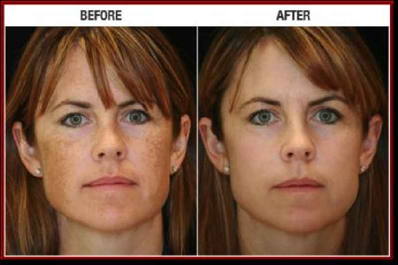 Can dermatologist remove age spots