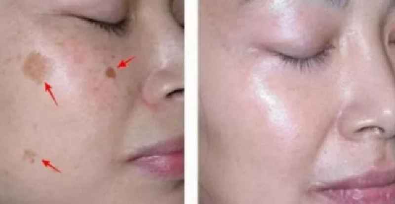 Can dermatologist remove dark spots on face