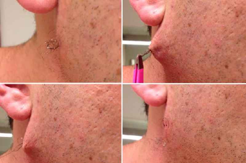 Can dermatologist treat ingrown hairs