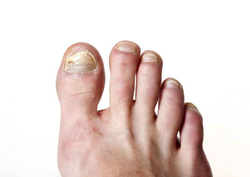 Can diabetes cause nail infections