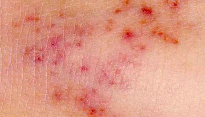 Can dimethicone cause a rash
