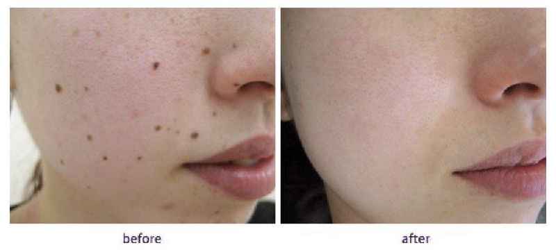 Can esthetician remove moles