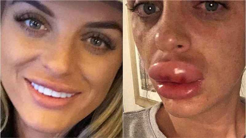 Can estheticians do lip injections